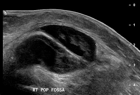 Baker Cyst Hemorrhagic Image Radiopaedia Org