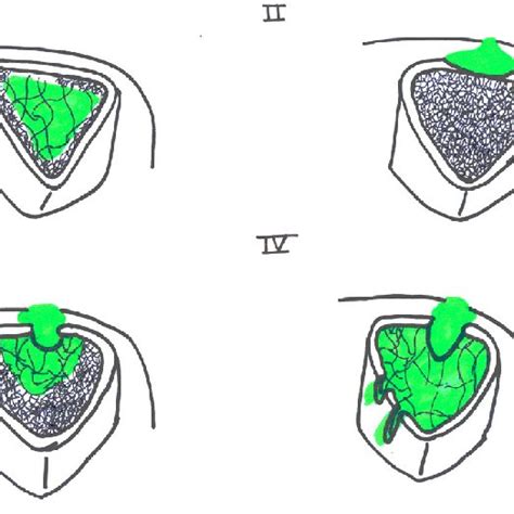 Risk Factors Differences According To The Osteomyelitis Cause