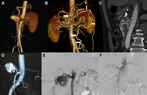 Strategies For Endovascular Treatment Of Complicated Splenic Artery Aneurysms Journal Of