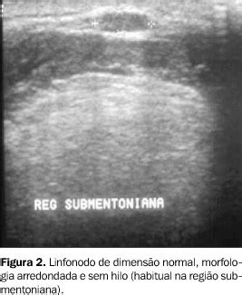 Scielo Brazil Linfonodos Cervicais Um Dilema Para O Ultra