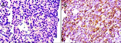 Epithelioid Gist A Cellular Tumor With Sheets Of Round To Ovoid