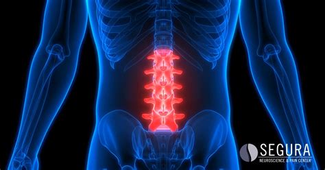 Chronic Back Pain - Segura Neuroscience & Pain Center