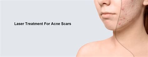 Professional Laser Treatment For Acne Scars | PrettyLasers