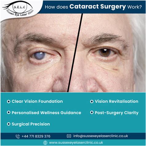 Recovering From Cataract Surgery Everything You Need To Know