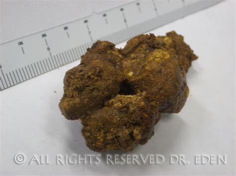 Gallstone Pictures Gallery See Images Of Real Gallstones Passed