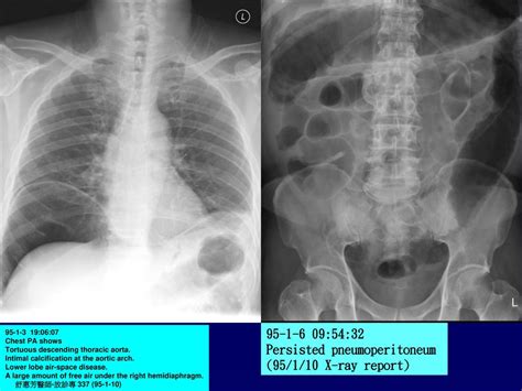 Gi Radiology Case 1 陳x貞 45 Year Old Female Ppt Download