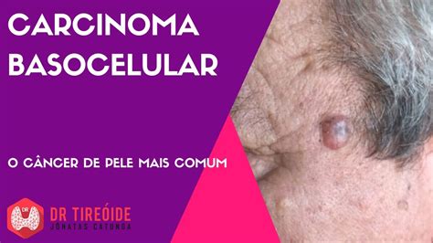 Carcinoma Basocelular O Tipo Mais Comum De Câncer De Pele Youtube