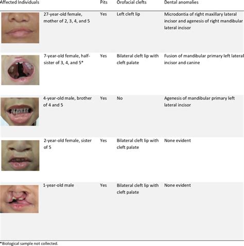 Phenotype Variation Of Individuals With Irf Ser Thr Variant And Van