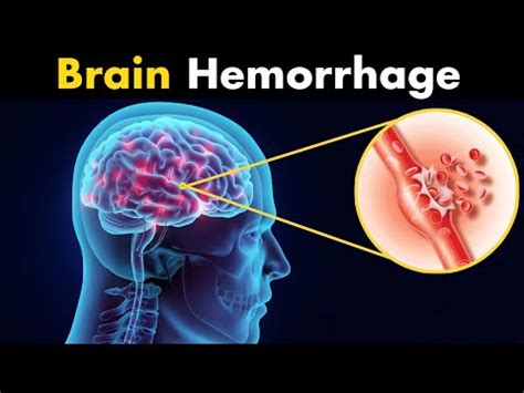 Top 18 Is A Brain Hemorrhage Painful Update