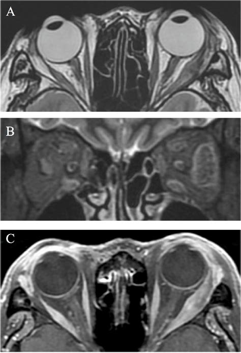 A: T2-weighted MRI showing thickening of the left rectus muscle with... | Download Scientific ...