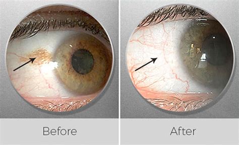 Contjunctival Nevus Removal Los Angeles | Assil Eye