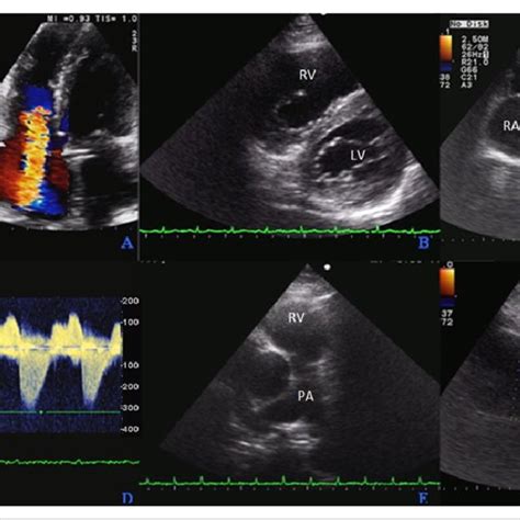 Echocardiographic Findings A Four Chamber View Showing Severe