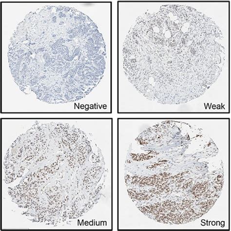 Immunohistochemical Intensity Of Brd In Breast Tumor Tmas Negative