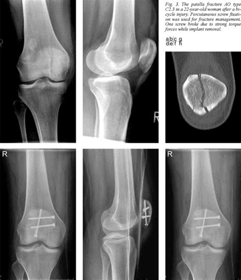 Figure 1 from Patellar fractures--a review of classification, genesis ...