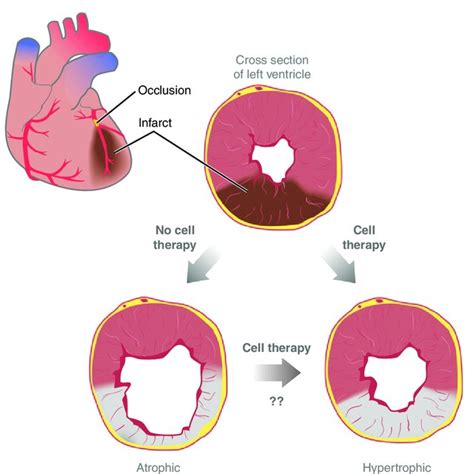 Pdf Cell Based Therapy For Myocardial Ischemia And Infarction