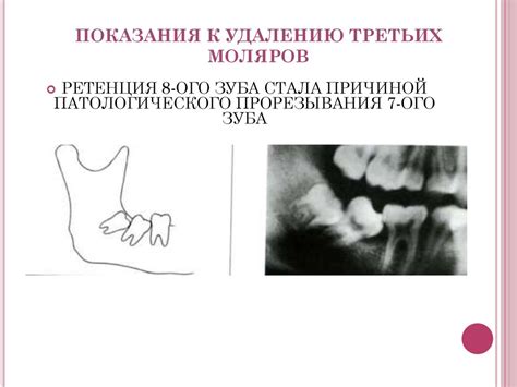 Удаление третьих моляров верхней и нижней челюсти. Ретенция и дистопия ...