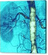 Arterial Stent Photograph By Zephyr Science Photo Library