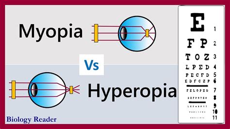 Difference Between Myopia And Hyperopia Examples And Comparison Chart