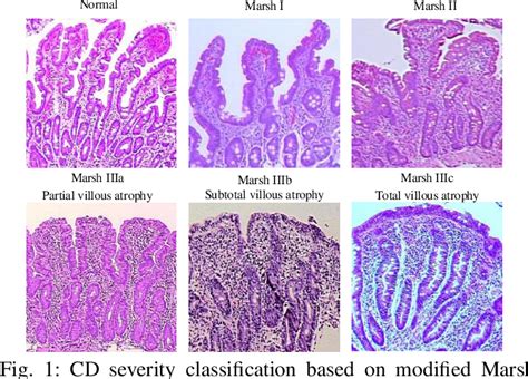 Figure 1 From Celiacnet Celiac Disease Severity Diagnosis On Duodenal