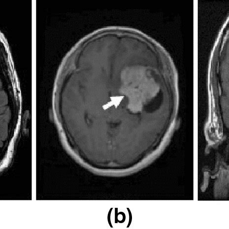 Detection And Classification Result Showing Glioma Meningioma And