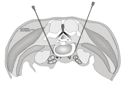 Superior hypogastric plexus block