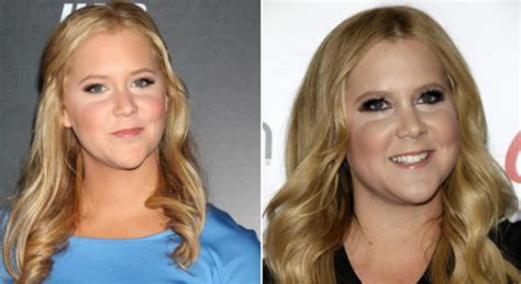 Amy Schumer Reveals Her Cushings Syndrome But What Is It The