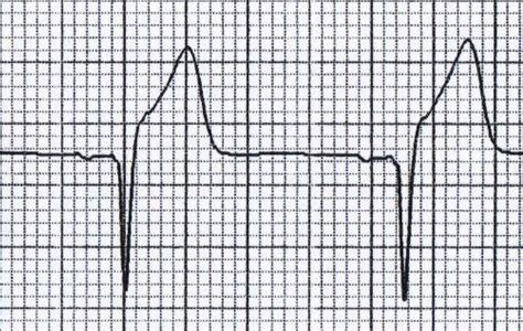 Subtle Ecg Findings In Acs Part Iii Benign Early Repolarization Vs Anterior Stemi Emdocs