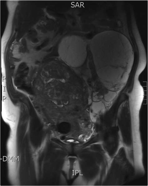 Pelvic MRI showing a huge uterine mass and a left adnexal complex cyst. | Download Scientific ...