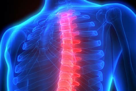 Osteophytes Thoracic Spine