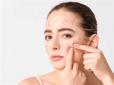 Does Dry Skin Make Acne Worse? - Westchester Dermatology Medical Clinic