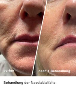 Collagen Fadenlifting Ohne Nadel Gegen Falten Medical Beauty Park