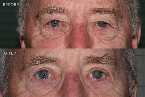 Under Eye Bag Surgery Before And After Photos Kirkland Bellevue Marina