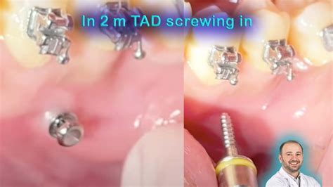 Interradicular Tad Insertion Between Lower Premolars Screwing In Mini