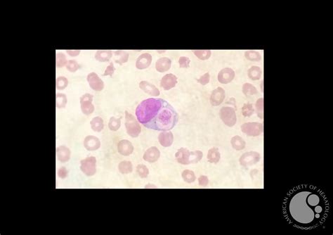 Platelet phagocytosis by a peripheral blood monocyte in a patient with haemophagocytic ...