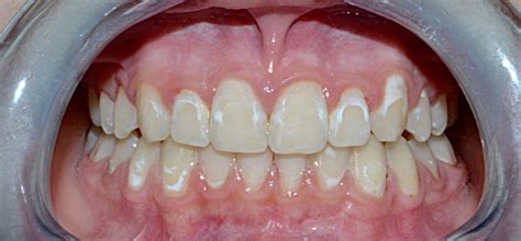 Efficacy Of Year Treatment Of Icon Infiltration Resin On