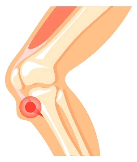 Icono De Dolor De Rodilla Anatom A De La Pierna Con Mancha Roja