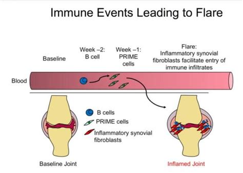 Nejm Prime细胞：预测风湿性关节炎发作的rna鉴定 知乎