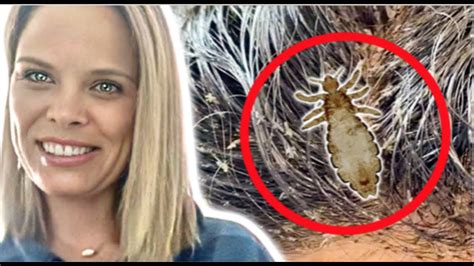 I Remove Head Lice For A Living Youtube