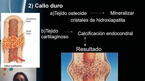 CONSOLIDACION OSEA YouTube