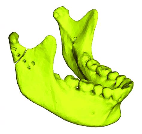 Finite Element Model Of Human Mandible With A Simulated Condylar