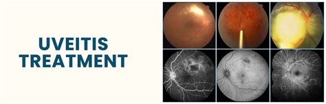 Uveitis Treatment Narayana Nethralaya