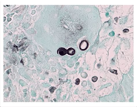 Specimen Stained By The Gomori Methenamine Silver Stain Method Download Scientific Diagram