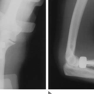 Anteroposterior A And Lateral B Radiographs Of The Right Knee Show