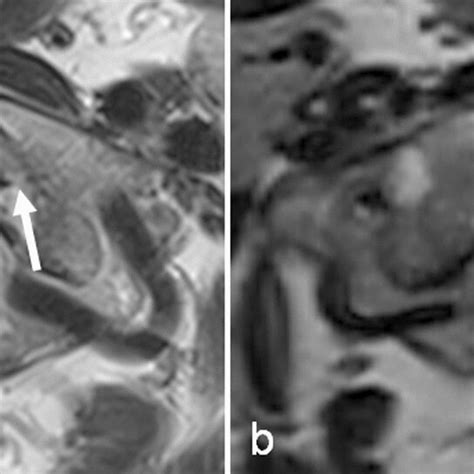 A 67 Year Old Woman Who Underwent Cervical Spine Mri For The Evaluation