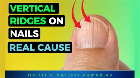 The Real Causes Of Vertical Ridges On Your Nails Youtube