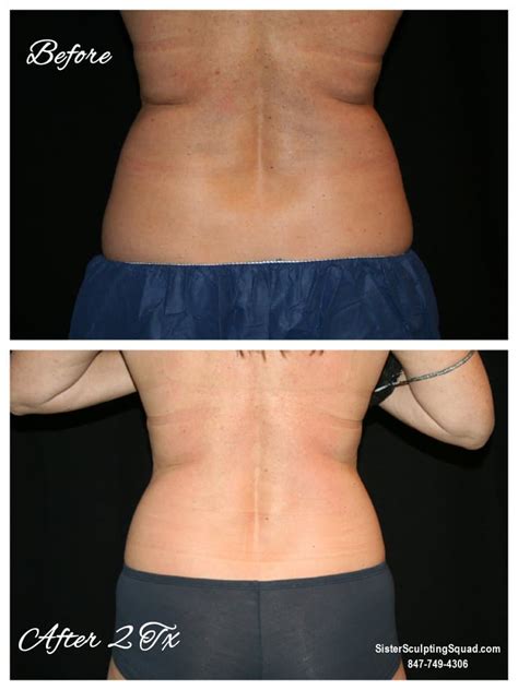 Coolsculpting Before And After Photos Riverside Medical Sc