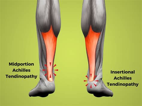 Achilles Tendinopathy In Runners An Evidence Based Guide