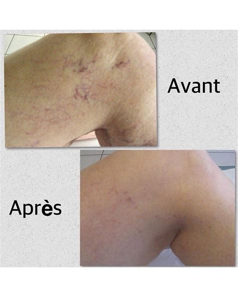 Traitement laser des varicosités à Angers Docteur Delorme