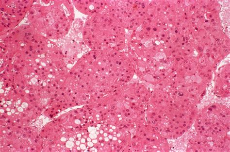 Liver Cancer Photograph By Cnriscience Photo Library Pixels