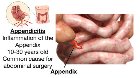 Ruptured Appendix Symptoms